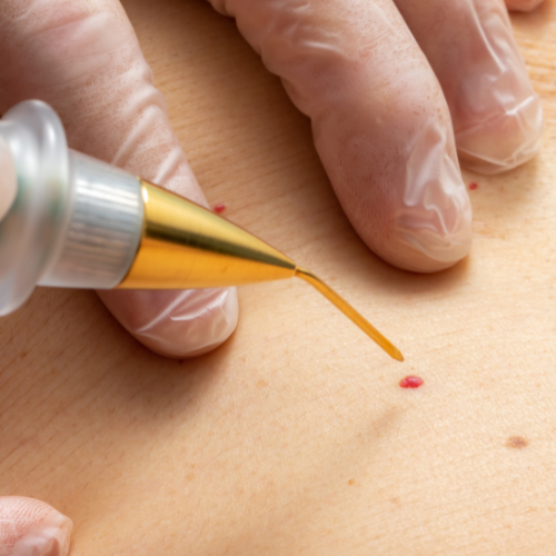 Cherry Angioma Removal