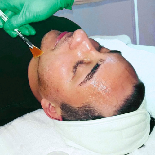 TCA Peel