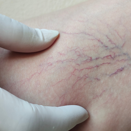 Spider Vein Removal